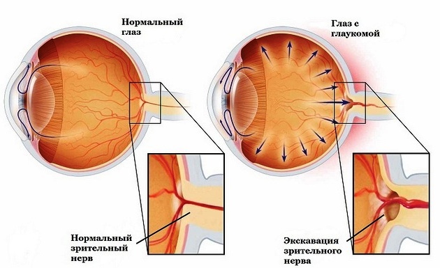 Строение глаза с глаукомой