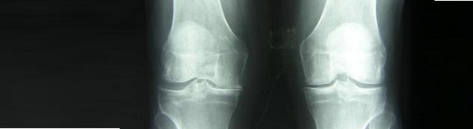 7 показаний для рентгена коленного сустава в двух проекциях