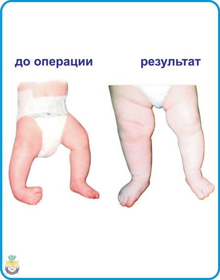 3 этапа косолапости у детей признаки и лечение.