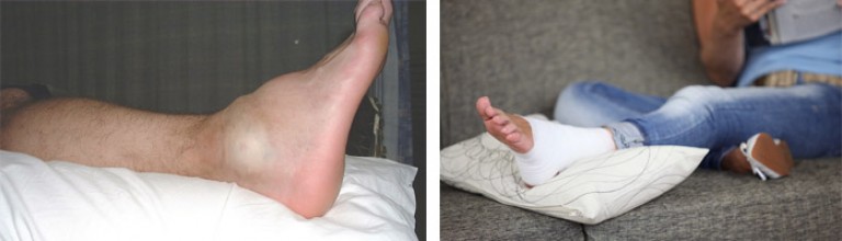 Сколько будет болеть нога после перелома лодыжки?