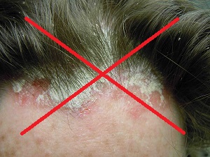 Грибковое заболевание волосистой части головы