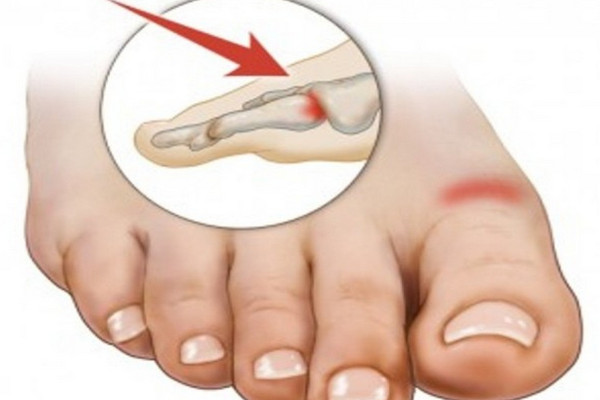 6 причин боли в суставе большого пальца ноги