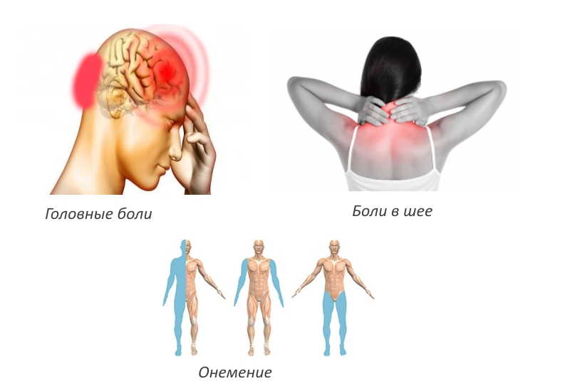 Корешковый остеохондроз или синдром: шейный, грудной, поясничный, крестцовый.