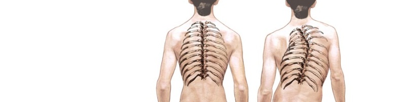Какое искривление позвоночника не поддаётся лечению и как не запустить свою спину?