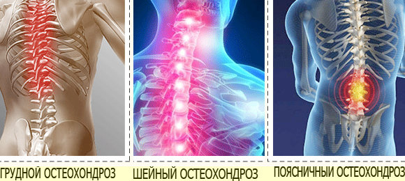 6 методов диагностики для определения остеохондроза