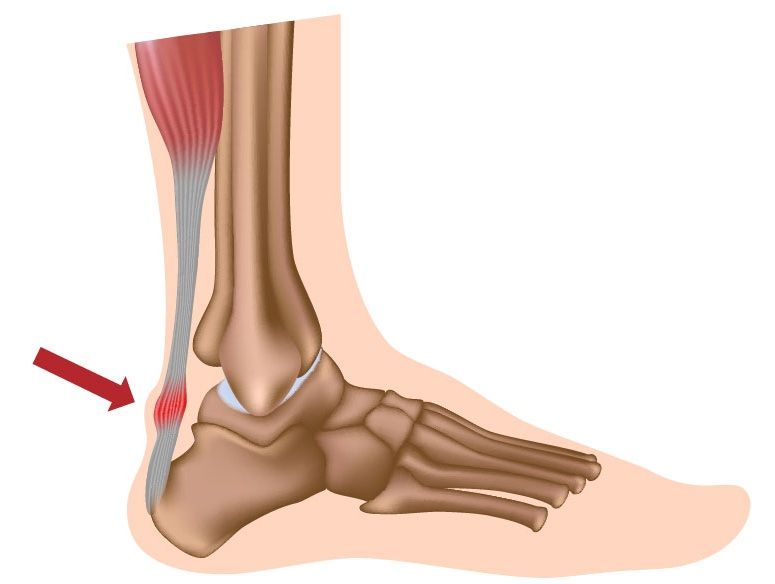 9 причин боли в пятках и ступнях ног