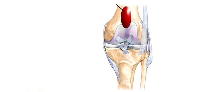 3 эффективных метода лечения бурсита коленных суставов