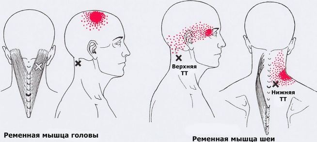 11 возможных заболеваний, когда болит шея и отдаёт немного в голову. Проверьте себя, возможно вам нужно в больницу!