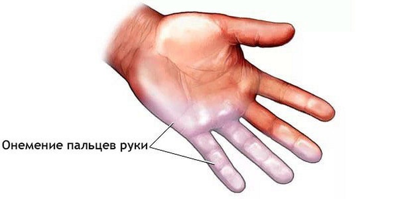Онемение пальцев рук: причины, лечение, что делать?