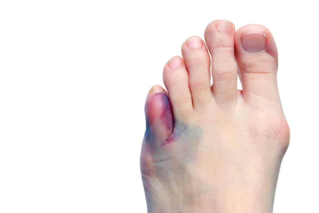 4 отличия чтобы определить перелом у Вас или ушиб пальца ноги