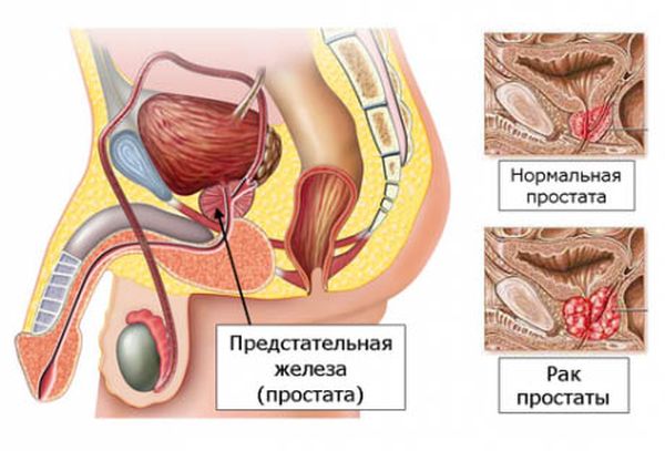 Рак предстательной железы у мужчин