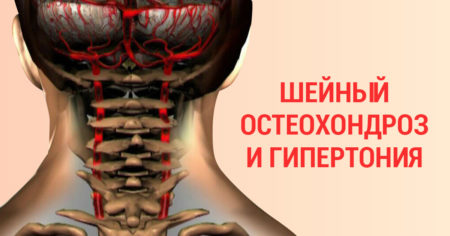 Причины шейного остеохондроза и артериального давления, связь между двумя диагнозами