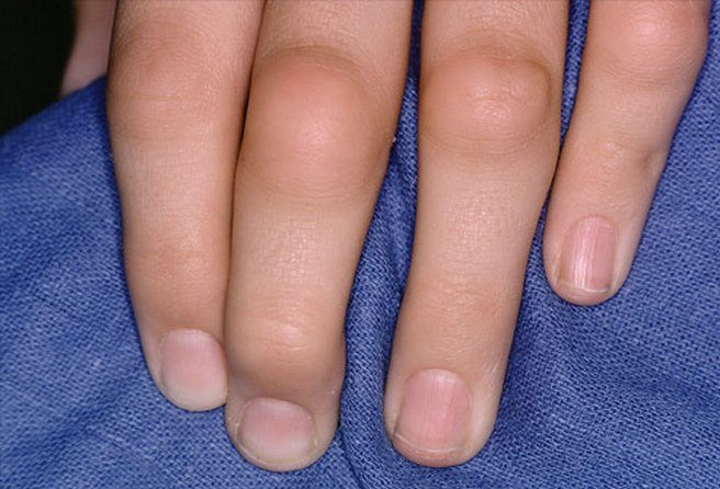 7 причин отёка (опухоли) пальца на руке, что делать?
