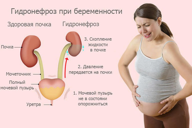 Чем опасен нефроптоз для беременных