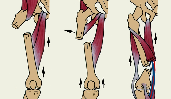 8 симптомов диафизарного перелома бедренной кости. Какие особенности?