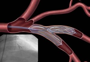 Сколько живут после стентирования сердца?