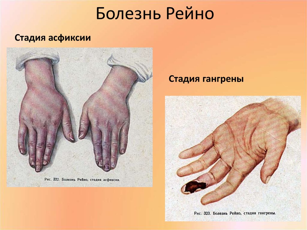 Онемение или покалывание пальцев правой руки. 15 возможных болезней
