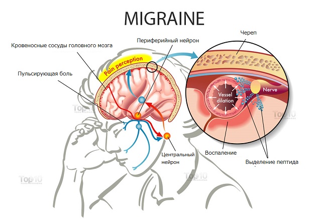 Как формируется мигрень