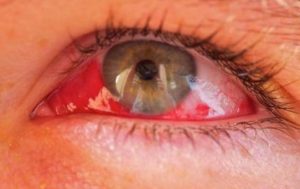 Кровоизлияние в глаз: причины и лечение патологии