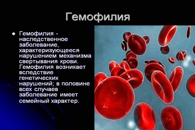Кровь в моче при гемофилии