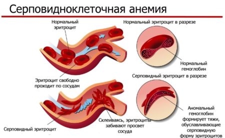 Причины, симптомы и лечение серповидной формы анемии