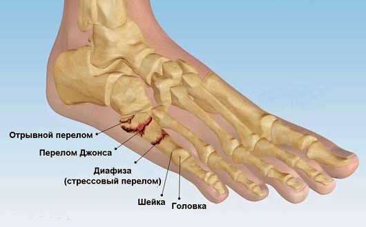 Перелом разных костей стопы 4 признака и лечение