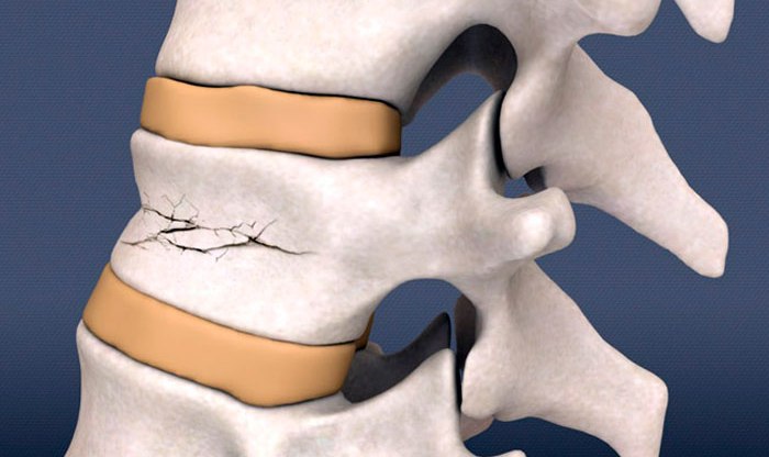 Как перенести человека с переломом спины, чтобы не навредить ему?
