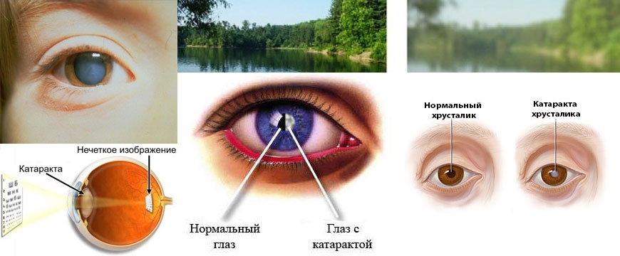 Ухудшение зрения при остеохондрозе шейного отдела, мерцание в глазах, какая взаимосвязь?