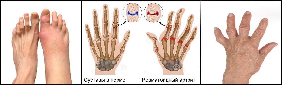 Почему болят суставы пальцев рук связь с заболеваниями и лечение