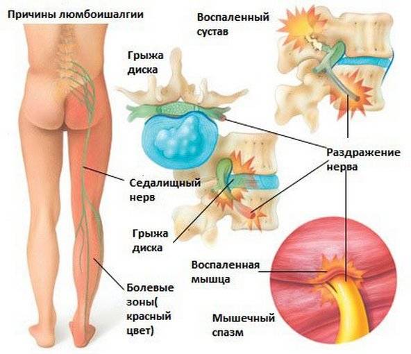 Почему боль в пояснице слева отдает в ягодицу или в ногу? 11 причин и лечение