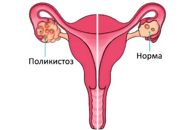 Поликистоз яичников – что это такое