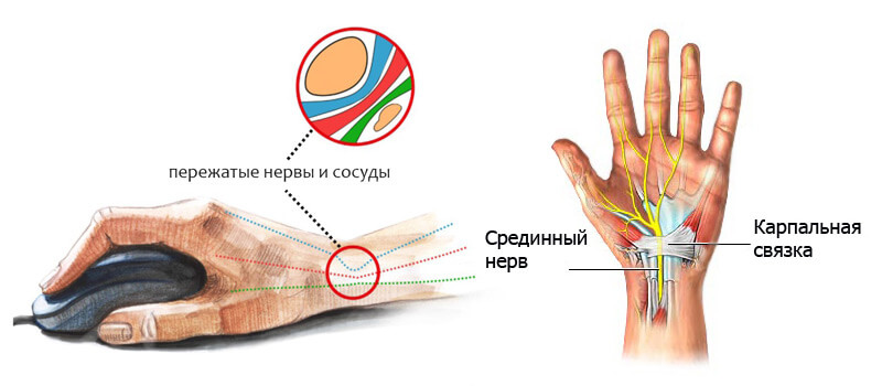 Немеют пальцы рук что делать и как лечить? 7 методов