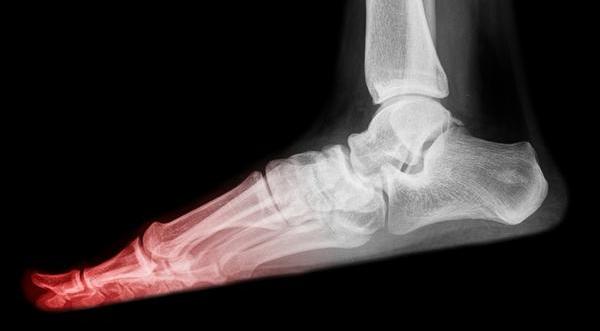 Перелом большого пальца ноги 4 признака, ношение гипса и реабилитация