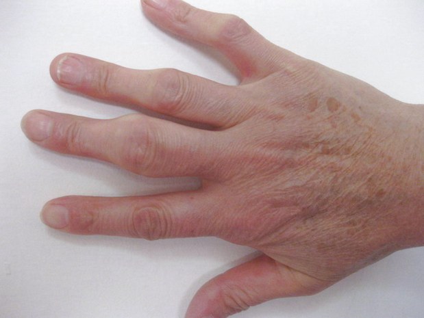 Опухают суставы пальцев рук: причины, как и чем лечить?