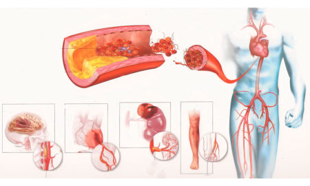 Виды лекарств от стенокардии при повышенном артериальном давлении, механизм действия, противопоказания, показания, побочные действия