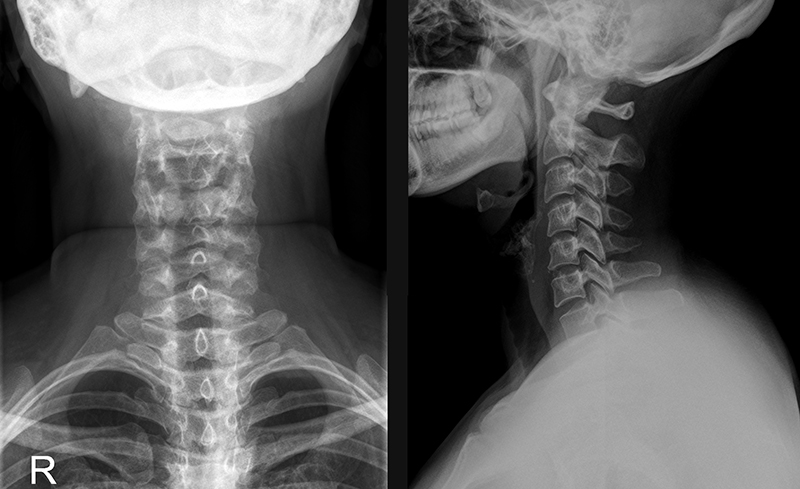 11 состояний, при которых нужен рентген шеи