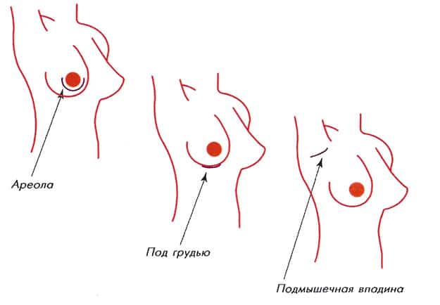 Виды разрезов при имплантации груди