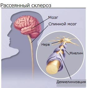 Как проявляется склероз голове
