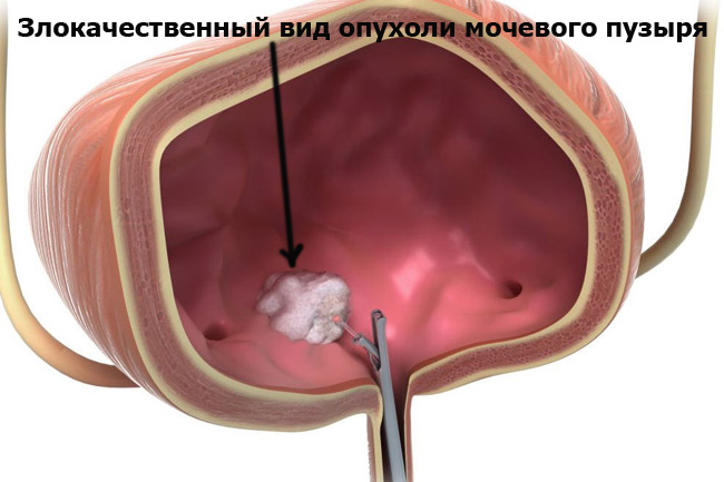 Злокачественная опухоль мочевого пузыря 