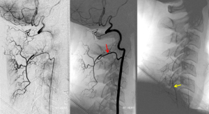 Снимок левой артерии