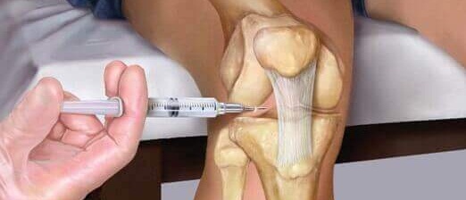7 причин скопления жидкости в коленном суставе, как не сделать ещё хуже?