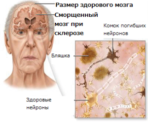 О старческом склерозе