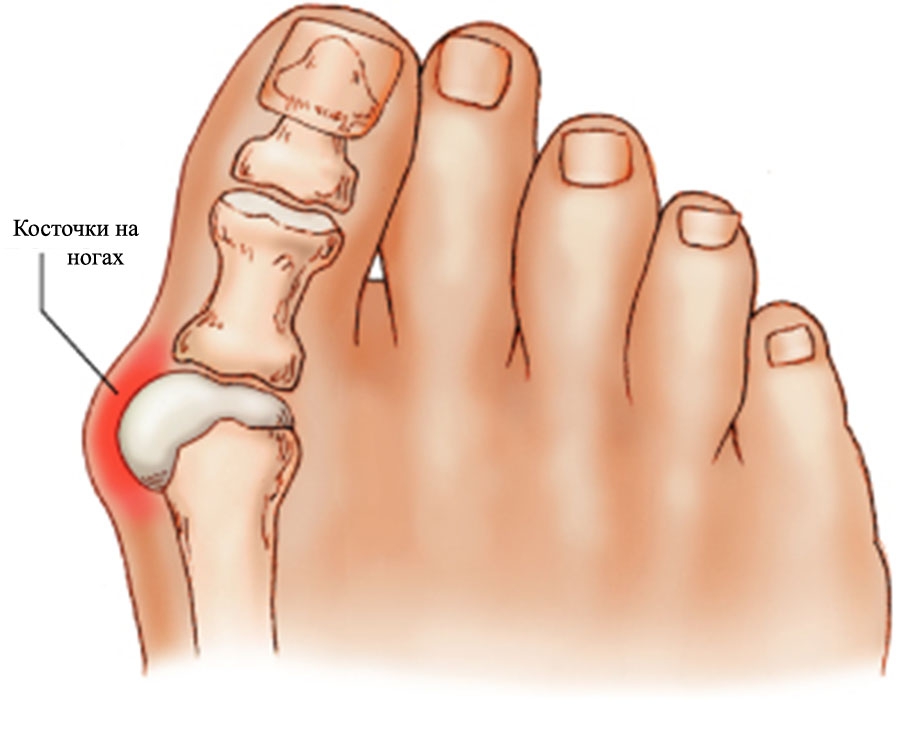 4 стадии деформации косточки на ноге, как лечить?