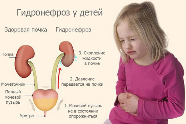 Детский почечный гидронефроз