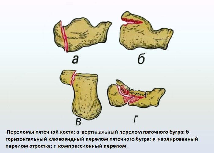 Перелом разных костей стопы 4 признака и лечение