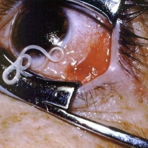 Дирофиллярий глаза