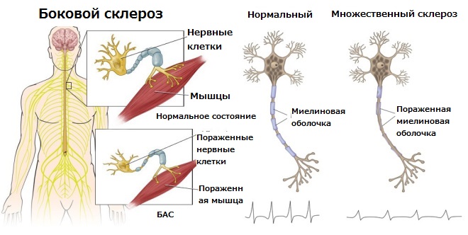 Здоровый и пораженный нейроны