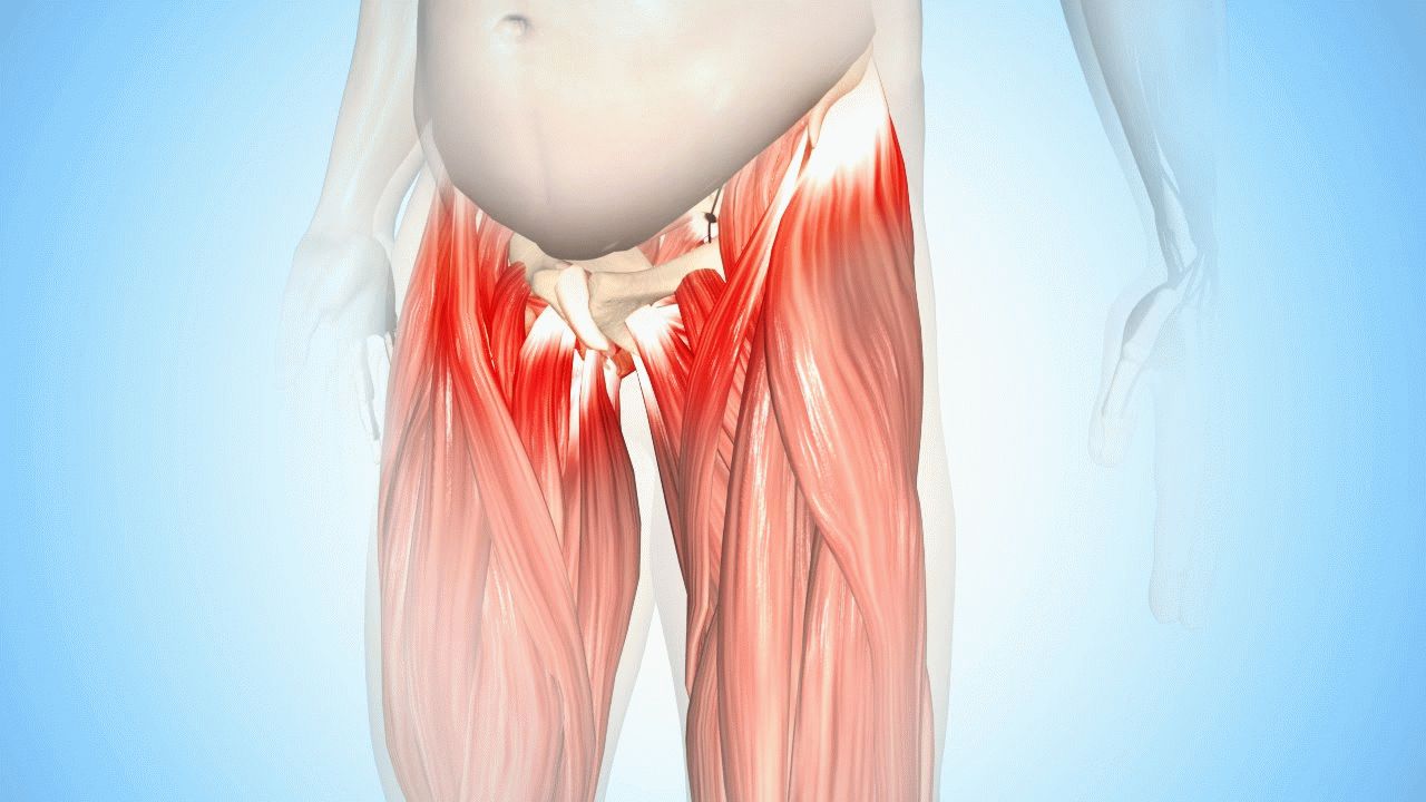 Воспаление бедренного сухожилия или тендиноз тазобедренного сустава, лечение.