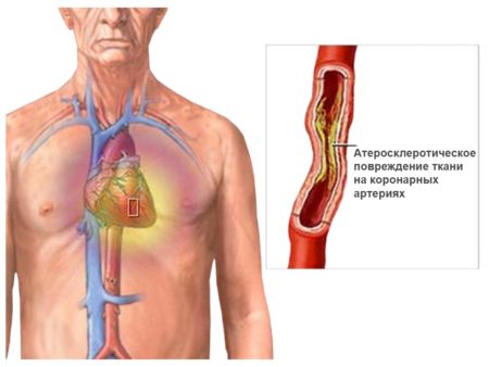 Свойства Валидола, повышает или понижает артериальное давление, механизм действия, показания, противопоказания