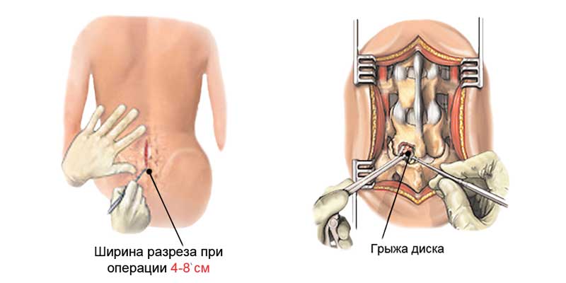 Операция по удалению грыжи позвоночника эндоскопом 8 последствий